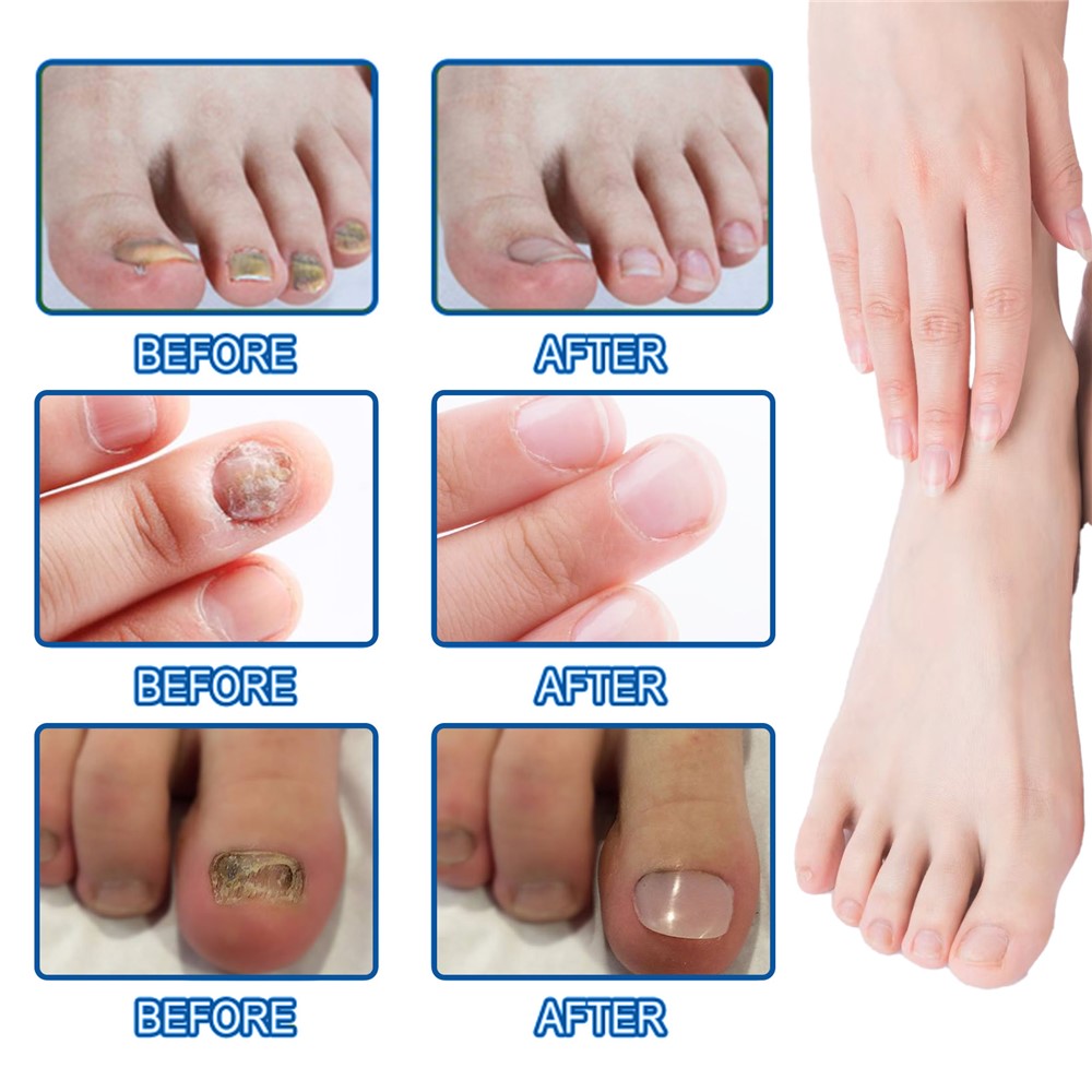 Nagelplåster mot nagelsvamp – 32-pack för nattbehandling
