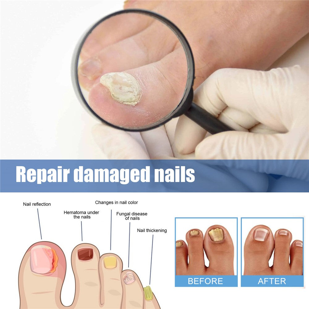 Nagelplåster mot nagelsvamp – 32-pack för nattbehandling